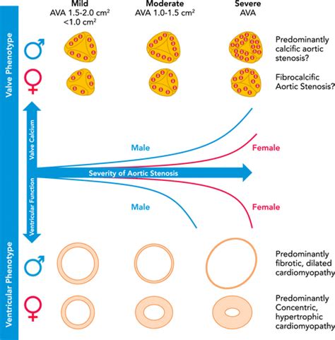 Pathophysiology Of Aortic Valve Stenosis Is It Both Fibrocalcific And Sex Specific Physiology