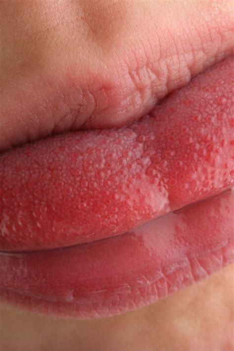 Swollen Taste Buds Causes Diagnosis And Treatment