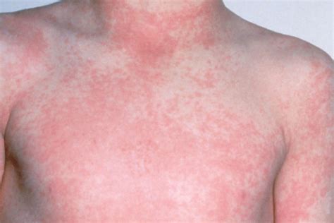 10 Common Skin Rashes In Children