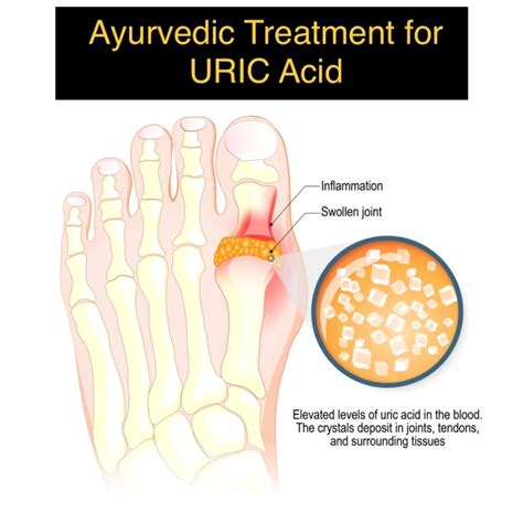 Ayurvedic Treatment For Uric Acid Ayur Bethaniya Hospital
