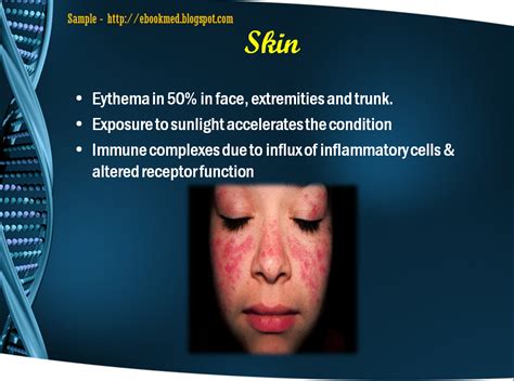 Systemic Lupus Erythematosus Powerpoint Presentation Free Download E Med