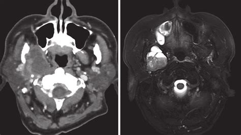 A An Axial Iv Contrast Enhanced Ct Scan Showing A 3 4 Cm Fat Containing