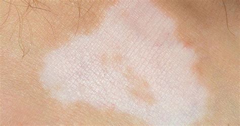 Psoriasis White Patches What Happens To Your Skin During A Flare Up