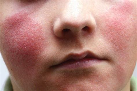 a visual guide to viral rashes viral rash rash on face skin breaking out