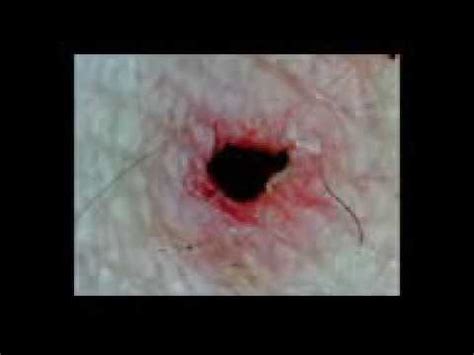If not properly treated, infections caused by ingrown hairs can travel to other parts of the body. Infected Ingrown Hair bloody pop - YouTube