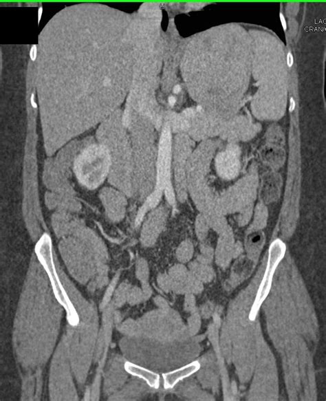 Normal Small Bowel With Neutral Contrast Small Bowel Case Studies