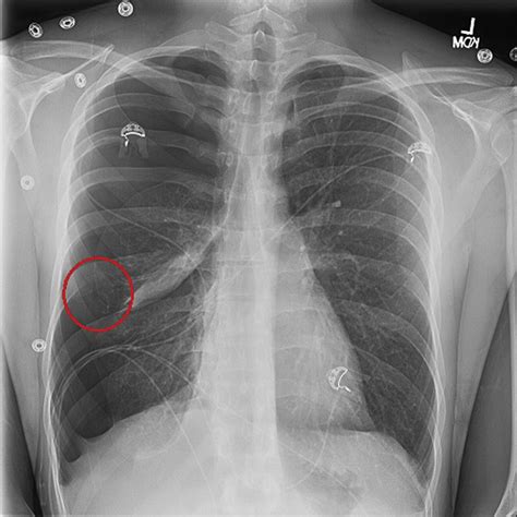 Of Spontaneous Pneumothorax Due To Ruptured Apical Bullae Blebs Images