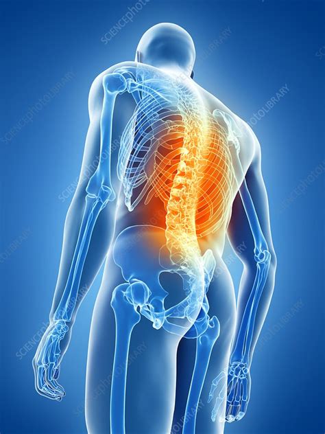 Back Pain Conceptual Illustration Stock Image F0268168 Science