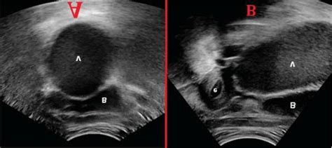 Ultrasound Aspect Of Hematocolpos Axial A And Longitudinal B