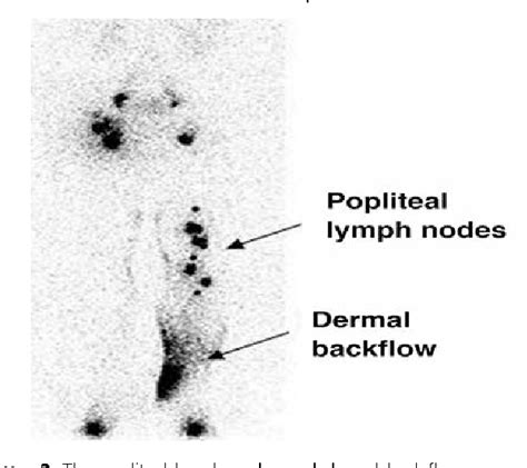 Figure 2 From Clinical Significance Of Lymphoscintigraphy Findings In