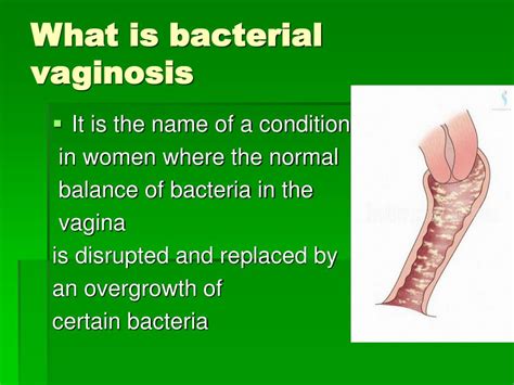 Ppt Bacterial Vaginosis Powerpoint Presentation Free Download Id