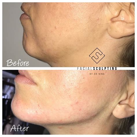 Jawline Fillers Facial Sculpting Jawline Fillers Specialist In London