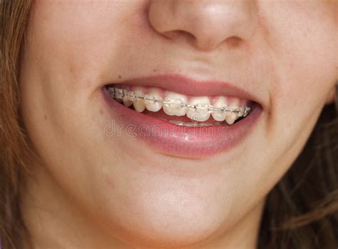 Pretty Smile With Braces Stock Image Image Of Perfect