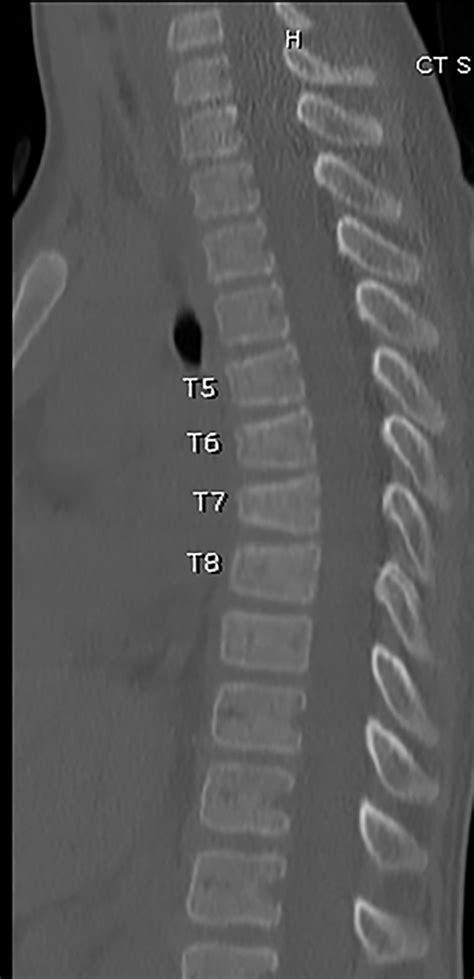 My Achin Back Vertebral Compression Fractures Radiology Key