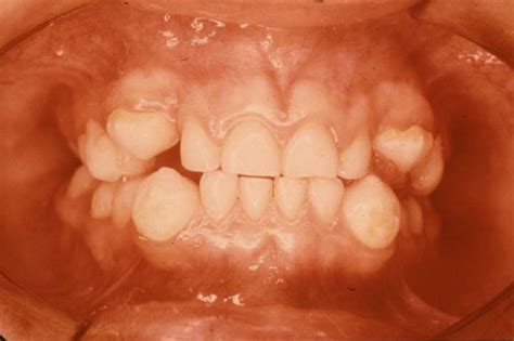 Abnormalites In Shape Of Teeth