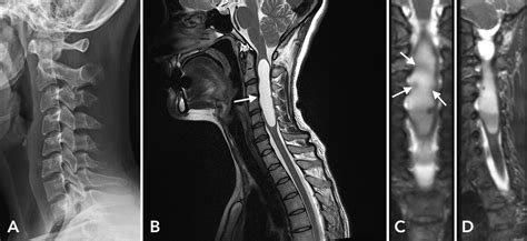 Cureus Multicentric Spinal Pilocytic Astrocytoma Presenting With