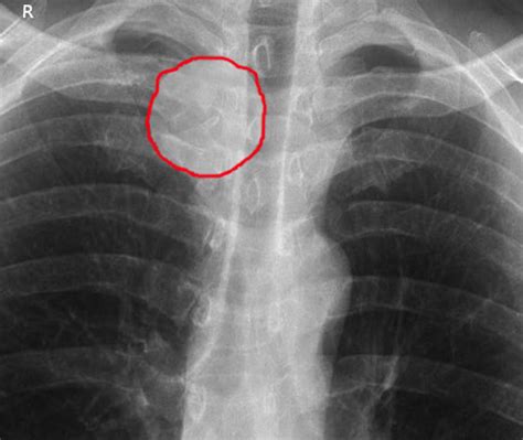 Sternoclavicular Joint Infection Statpearls Ncbi Bookshelf