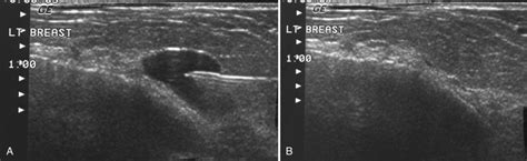 Mammographic And Ultrasound Guided Breast Biopsy Procedures Clinical Tree