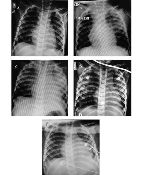 Chest Radiographic Manifestations Serial Chest Radiographs Of An