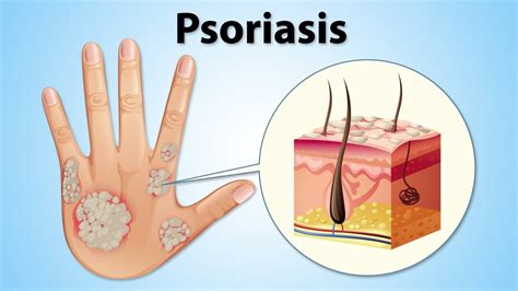 How To Naturally Treat Psoriasis Youtube