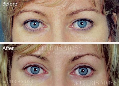 Eyelid Surgery Before And After Dr Chris Moss Plastic Surgeon