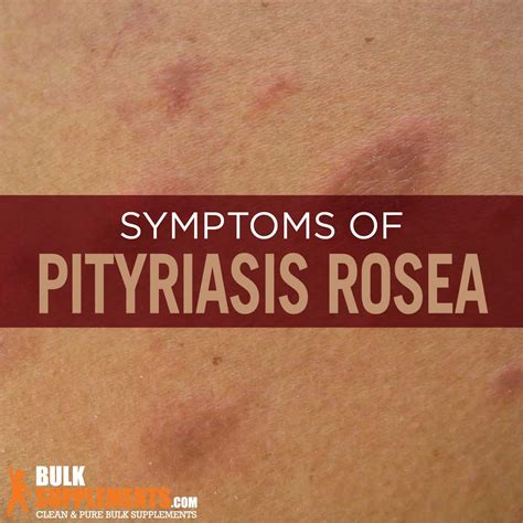 Pityriasis Rosea Symptoms Causes Treatment By James Denlinger