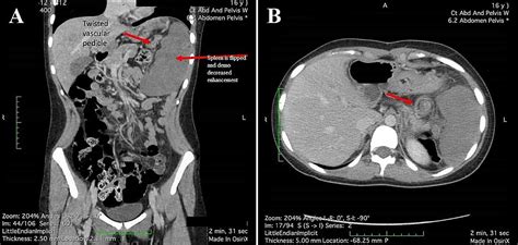Cureus Rare Cause Of Abdominal Pain In An Adolescent
