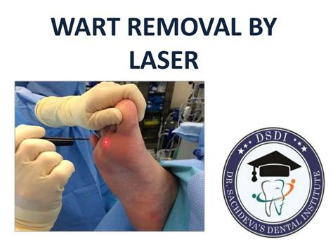 Wart Removal By Laser