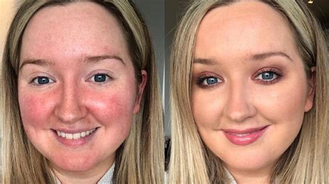 Rosacea 5 Things You Need To Know About Dealing With Red Cheeks Hello