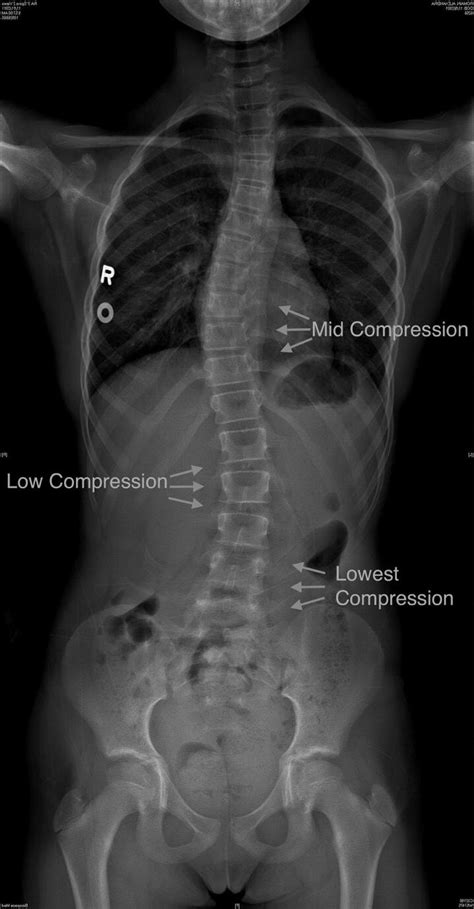 Read And Interpret X Ray And Radiologists Report For Scoliosis — Lyons