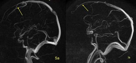 Superior Sagittal Sinus A Hypoplasia Of Anterior Of Superior