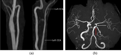 Figure 1 From Unilateral Agenesis Of Internal Carotid Artery Associated