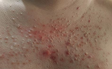 Chest Acne Begone Proven Solutions For Clear Skin