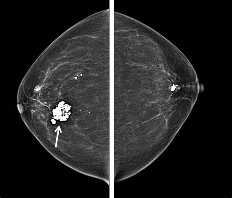 Popcorn Calcification Of Breast Radiology Cases