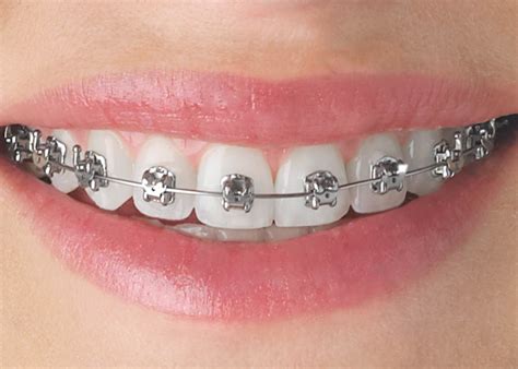 Are you conscious of the gaps between your teeth? Orthodontics — Northern Beaches Family Dental