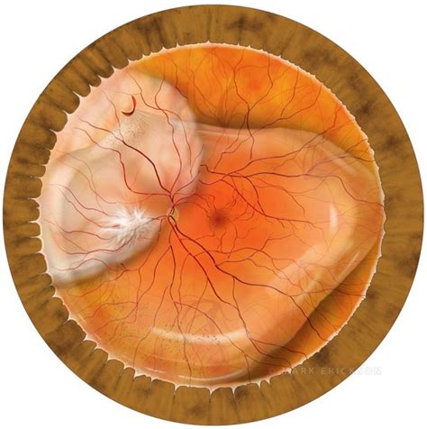 Horseshoe Retina Tear With Vitreous And Retinal Detachment Illustration