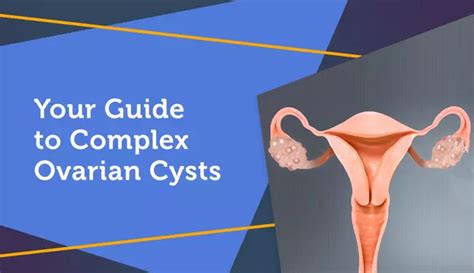 Your Guide To Complex Ovarian Cysts Myovariancancerteam
