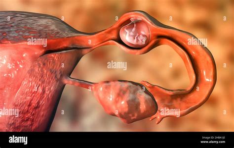 Grossesse Extra Utérine De L Illustration L Embryon A Implanté Dans La Trompe De Fallope Et