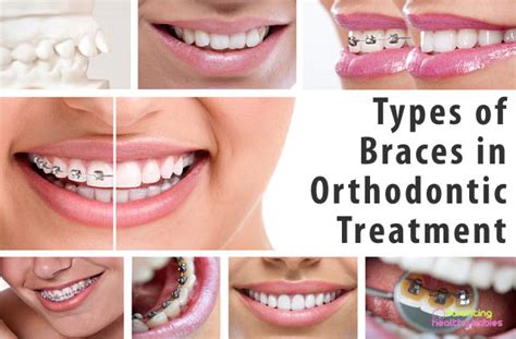 7 Most Common Types Of Braces Used In Orthodontic Treatment