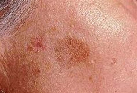 White Flaky Spots On Skin Submited Images Pic2fly