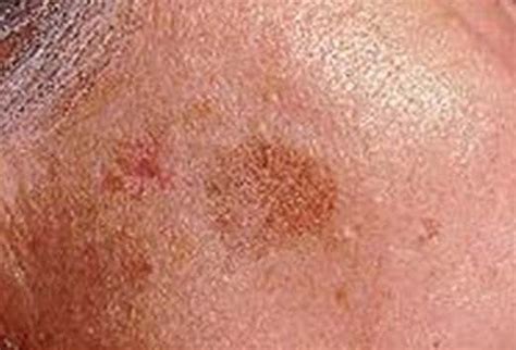 Disorders Of Pigmentation Slideshow