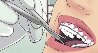 How to apply wax to your braces. How to Apply Dental Wax on Braces: 12 Steps (with Pictures)