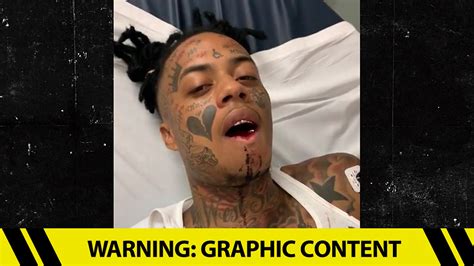 Rapper Boonk Recovers From Broken Jaw Surgery After Getting Punched