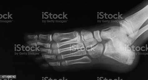 Xray Image Of Foot Oblique View Stock Photo Download Image Now 2015