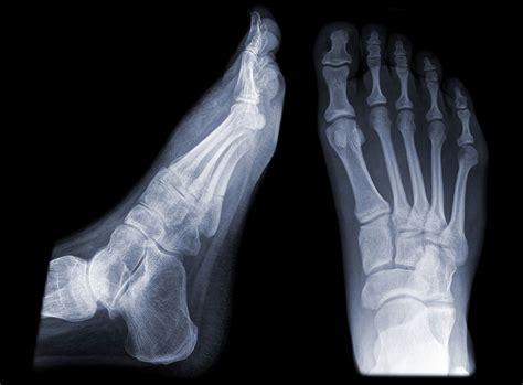 Return To Sports After A Lisfranc Injury Dr David Geier Sports