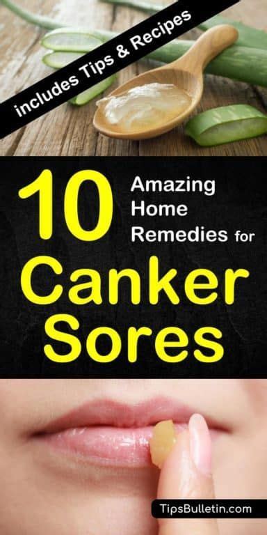 10 Amazing Homemade Solutions For Canker Sores Canker Sore Canker