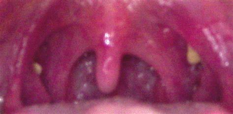 Tonsil Cancer White Lesion On Tonsil Maple Suyrup Diet