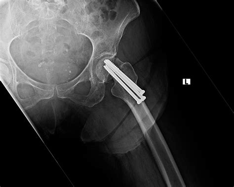 Ortho Dx Failed Hip Pinning Clinical Advisor
