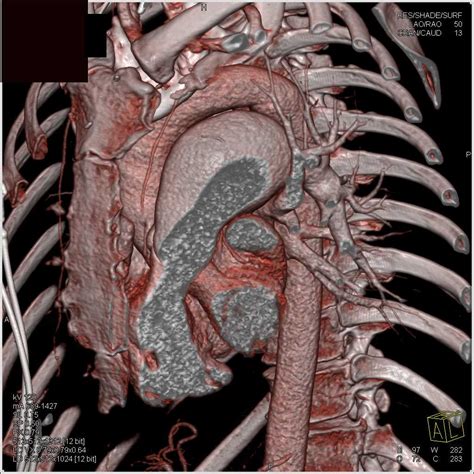 Aneurysmal Dilatation Of The Main Pulmonary Artery Chest Case Studies