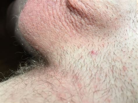 Help No Clue What These Small And Big Bumps Are Genital